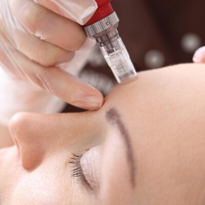 25% Off Skin Needling Treatments